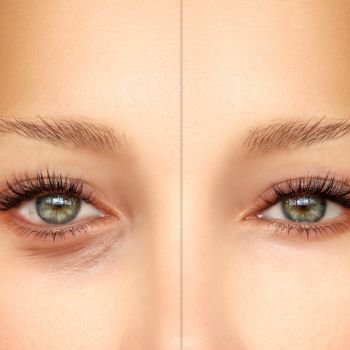 Blefaroplastia