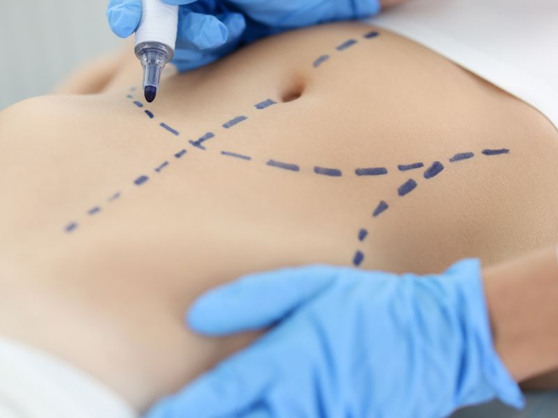 Cirurgia Plástica Abdominoplastia em Curitiba