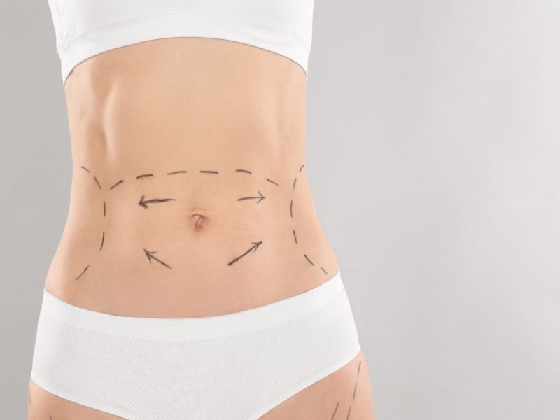 Cirurgia Plástica Mini-Abdominoplastia em Curitiba