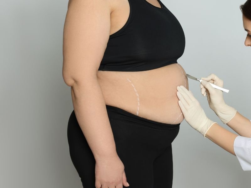 Cirurgia Plástica Pós-Bariátrica em Curitiba