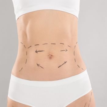 Mini-Abdominoplastia