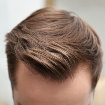 Transplante de cabelos