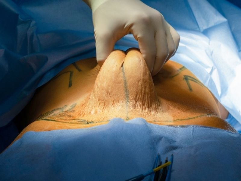 Abdominoplastia em Curitiba Recupere o Contorno Corporal