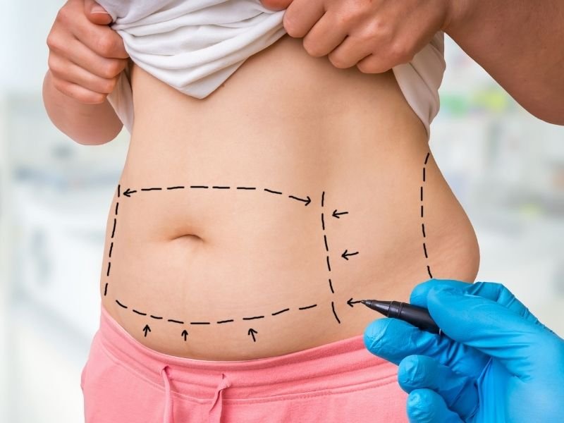 Abdominoplastia em Curitiba Recuperando a Firmeza e o Perfil Abdominal