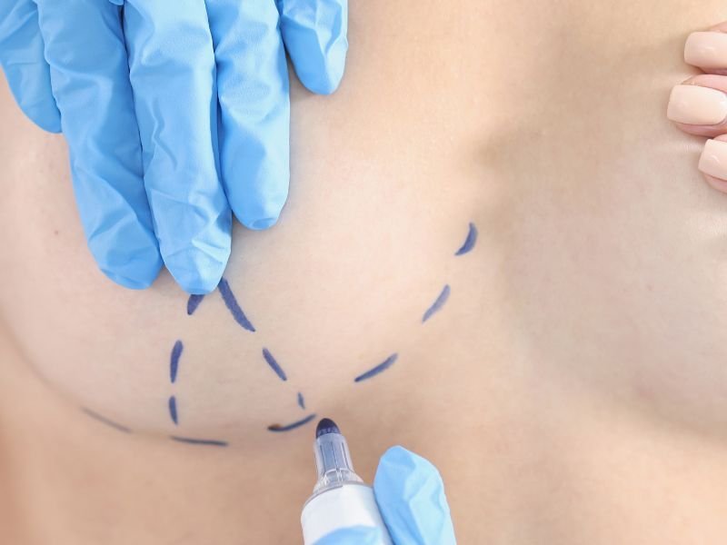 Cirurgia Plastica de Mastopexia em Curitiba