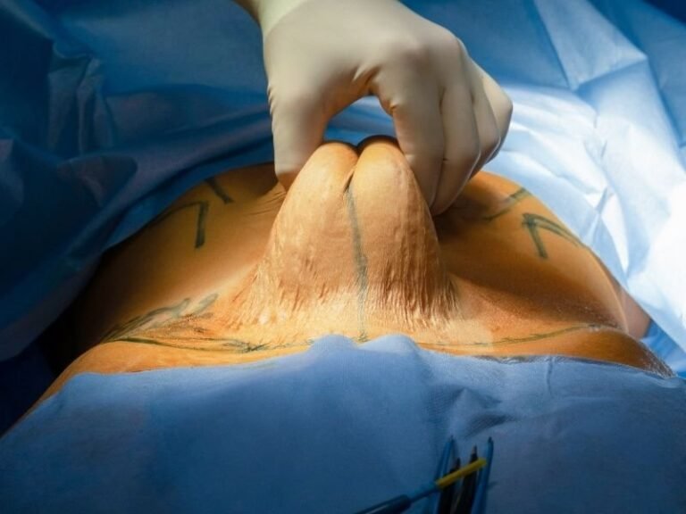Abdominoplastia em Curitiba Recupere o Contorno Corporal